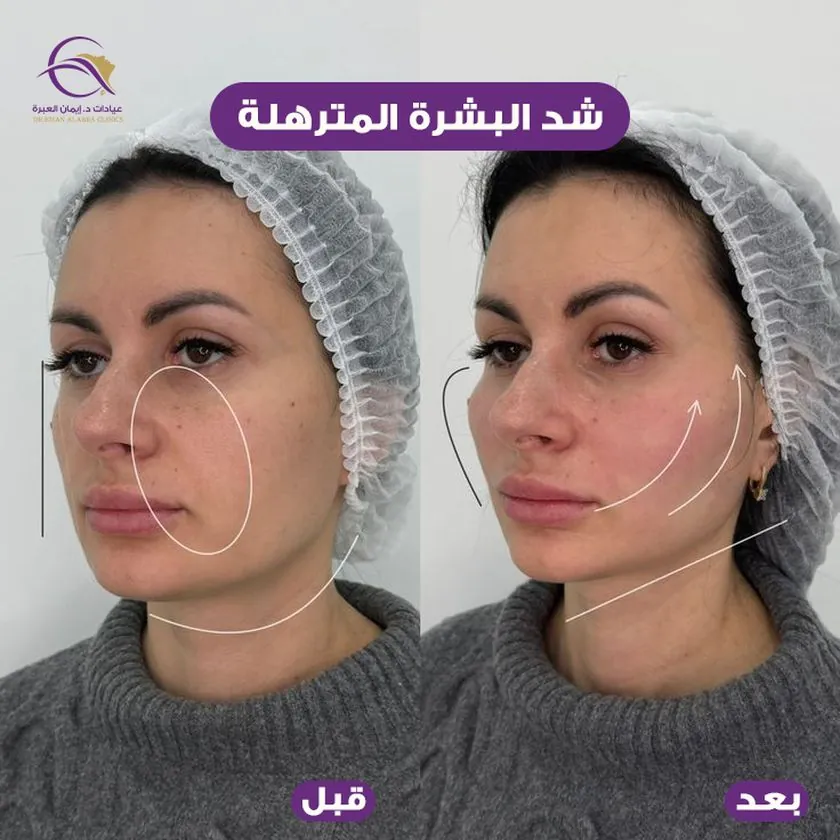 شد البشرة المترهلة
