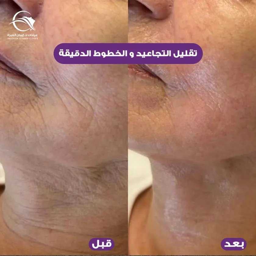تقليل التجاعيد والخطوط الدقيقة