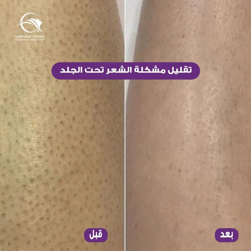 تقليل مشكلة الشعر تحت الجلد