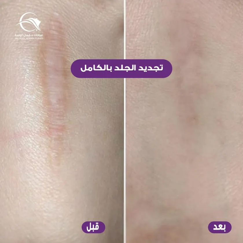 تجديد الجلد بالكامل