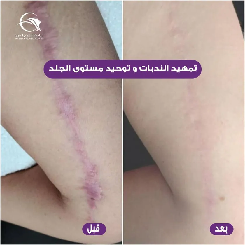 تمهيد الندبات وتوحيد مستوى الجلد