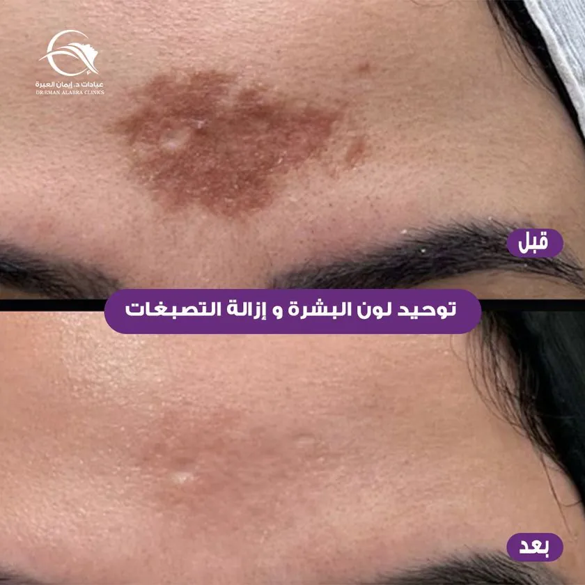 توحيد لون البشرة وإزالة التصبغات
