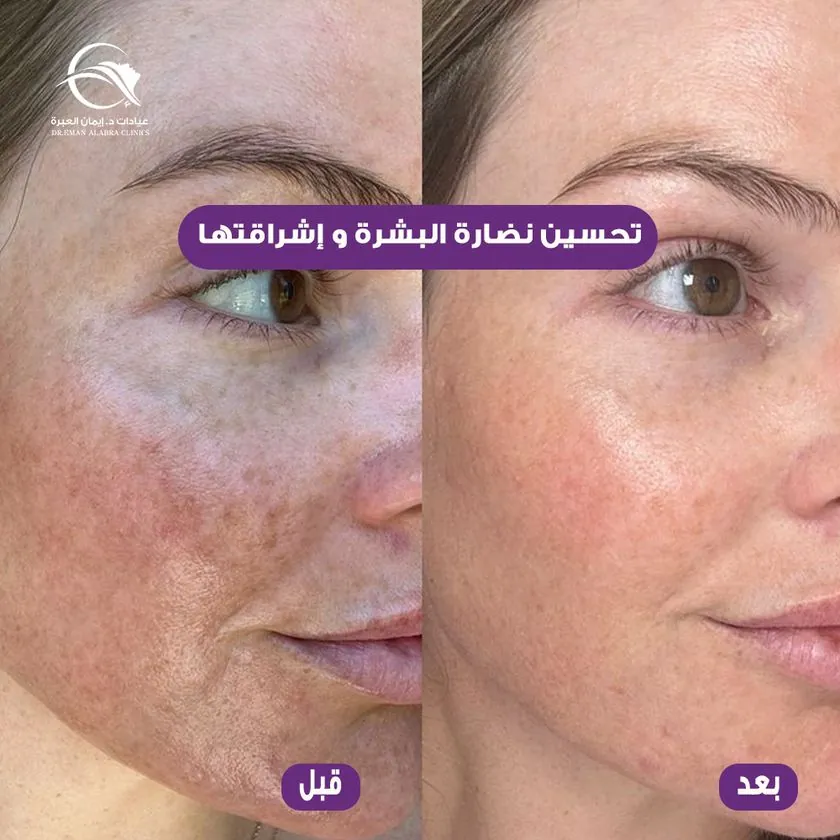 تحسين نضارة البشرة وإشراقتها