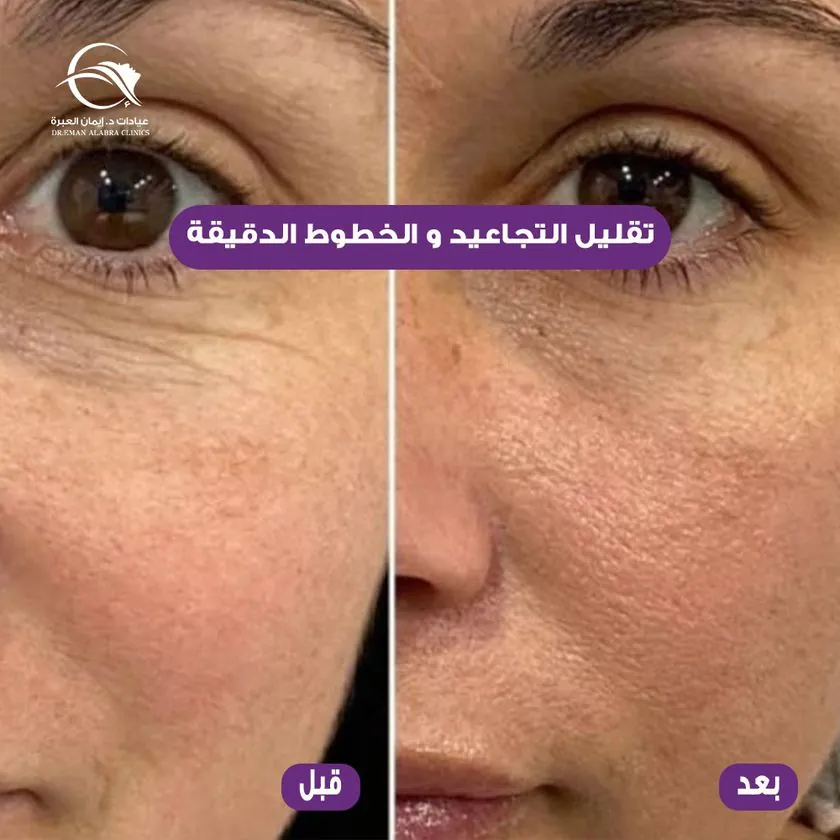 تقليل التجاعيد والخطوط الدقيقة