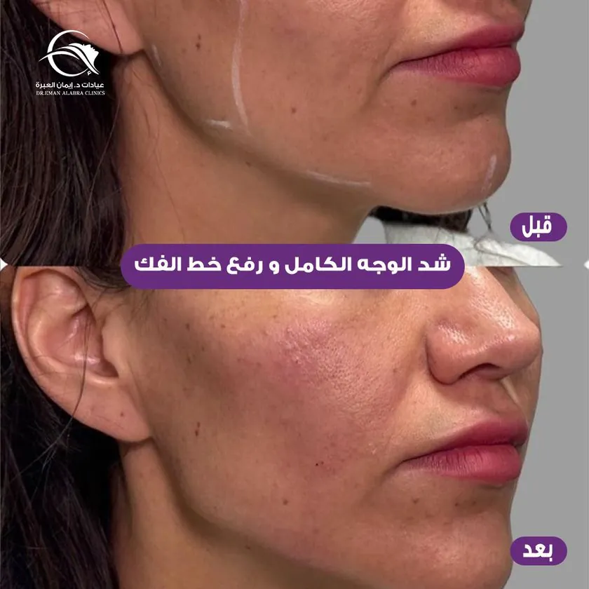 شد الوجه الكامل ورفع خط الفك