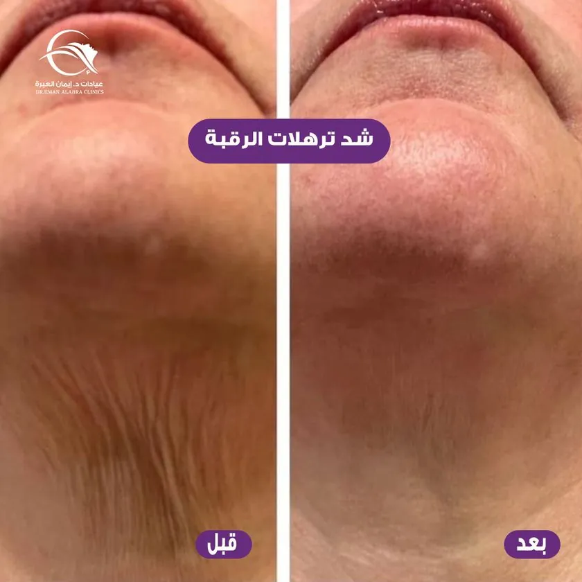 شد ترهلات الرقبة