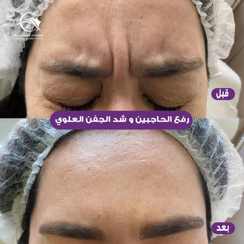 رفع الحاجبين وشد الجفن العلوي